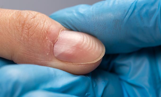Ongles recourbés vers l'extérieur