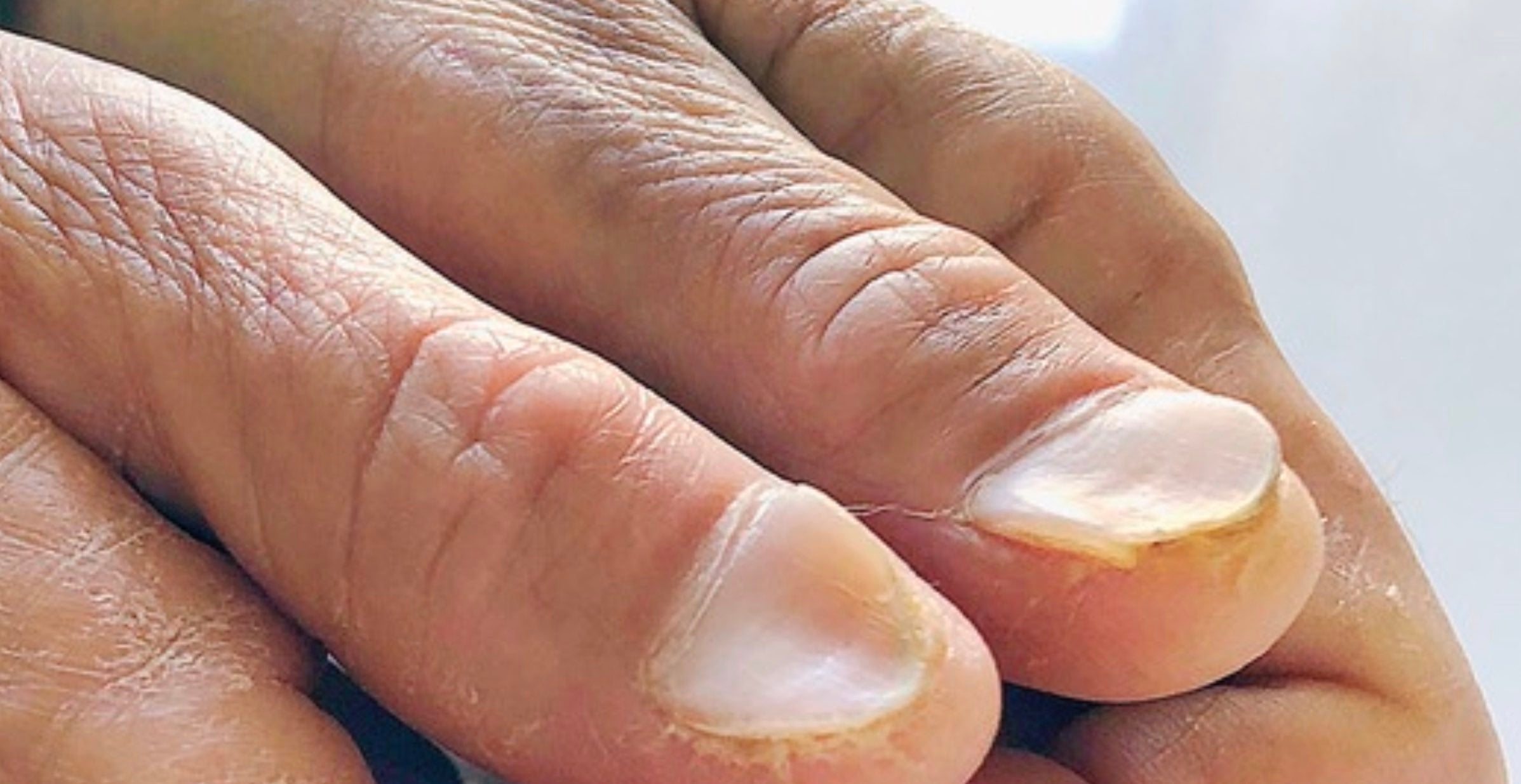 Ongle creusé en forme de cuillère