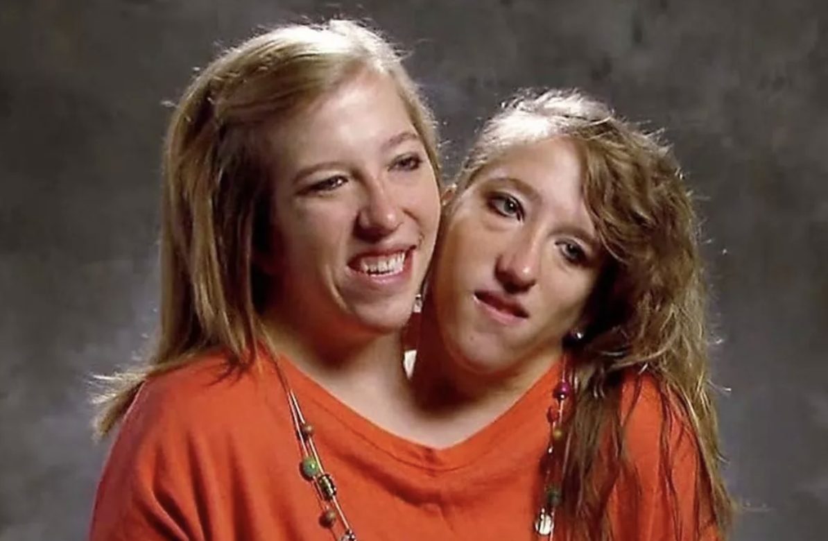 Abby et Brittany Hensel, jumelles siamoises