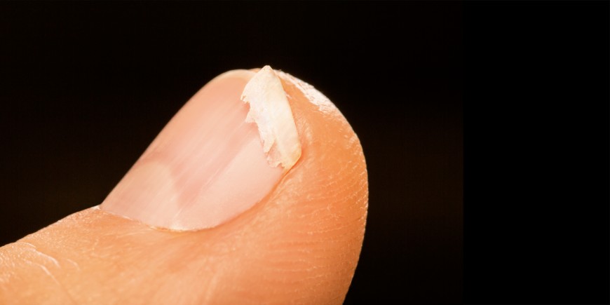 Ongles fragiles et striés verticalement