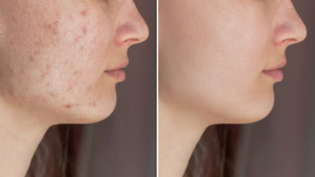 Comparaison avant/après traitement naturel pour les imperfections cutanées