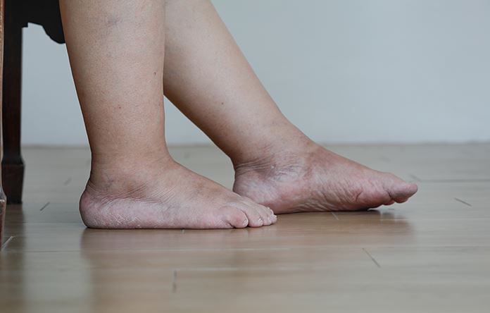 Pieds gonflés avec marques de chaussettes