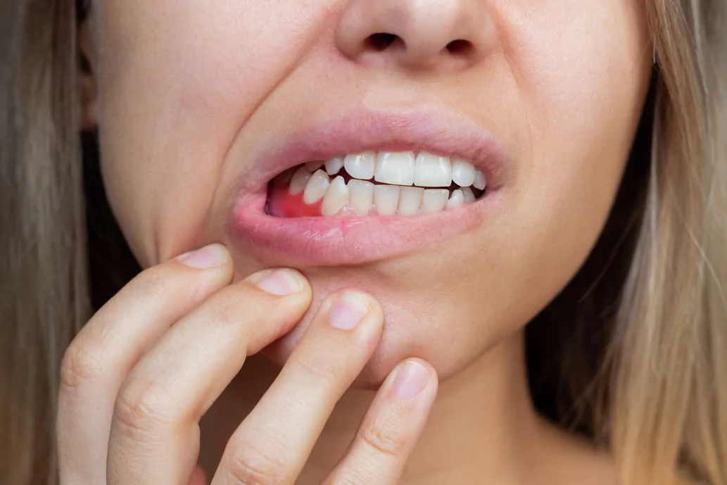Soin des gencives avec des produits naturels