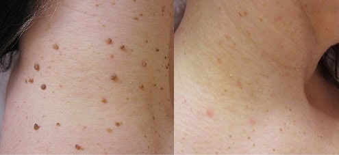 Comparaison avant/après traitement de verrue au vinaigre de cidre