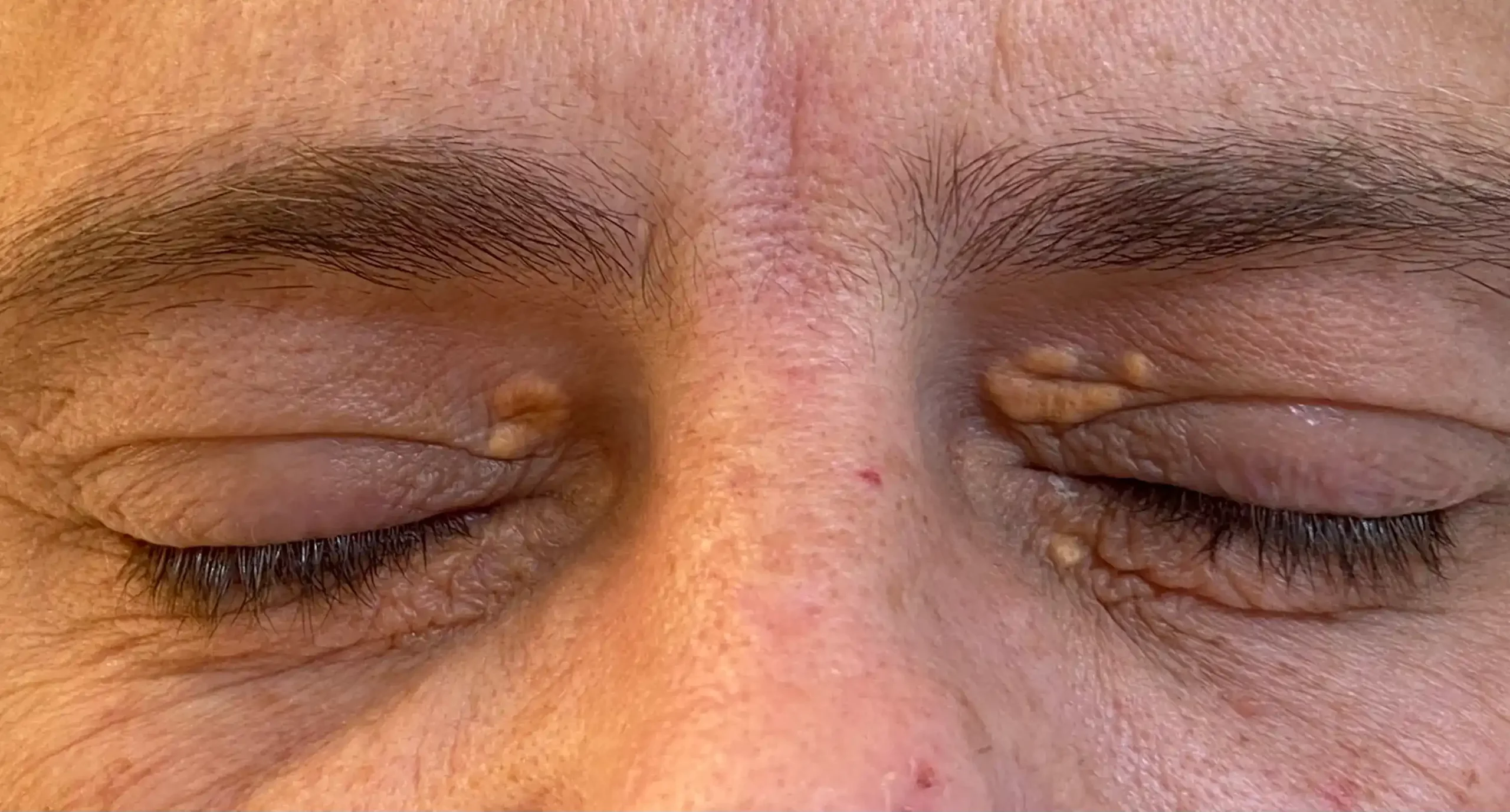 Comparaison avant/après traitement de xanthélasma