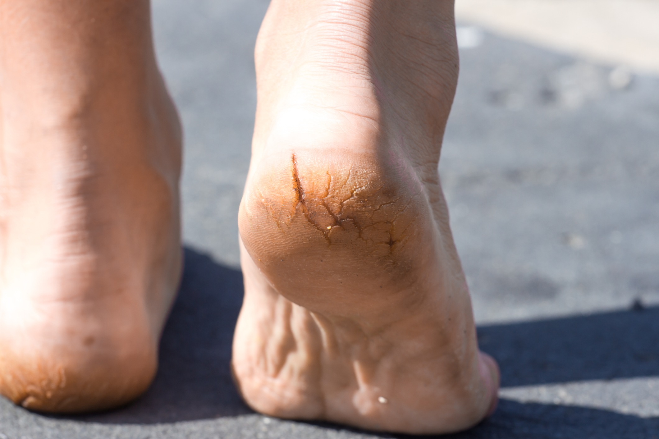 Talons crevassés nécessitant des soins