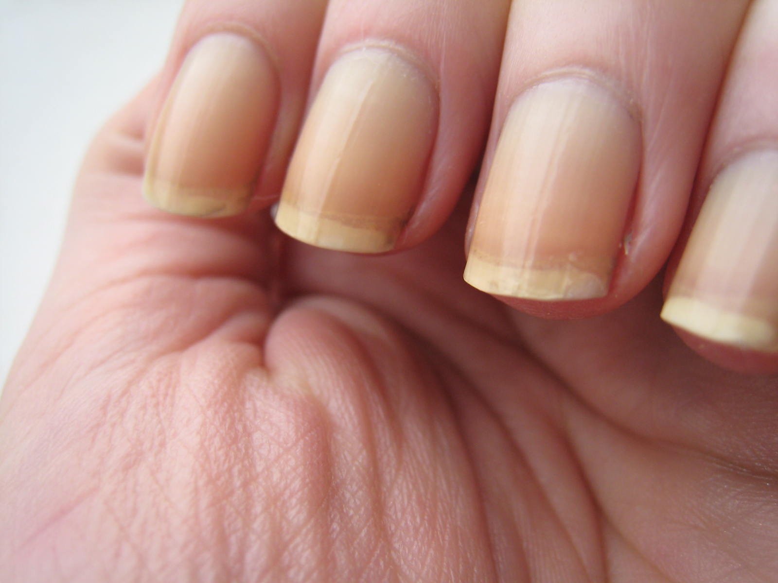 Ongles striés et fragiles