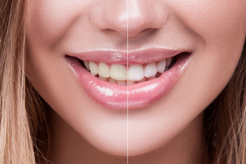 Comparaison avant/après blanchiment dentaire naturel