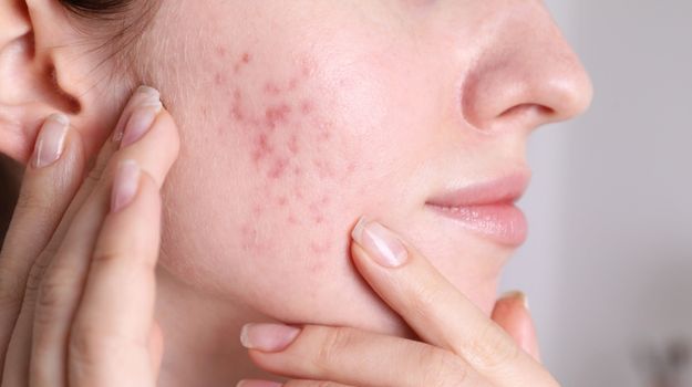 Jeune femme touchant délicatement une zone d'imperfection sur son visage