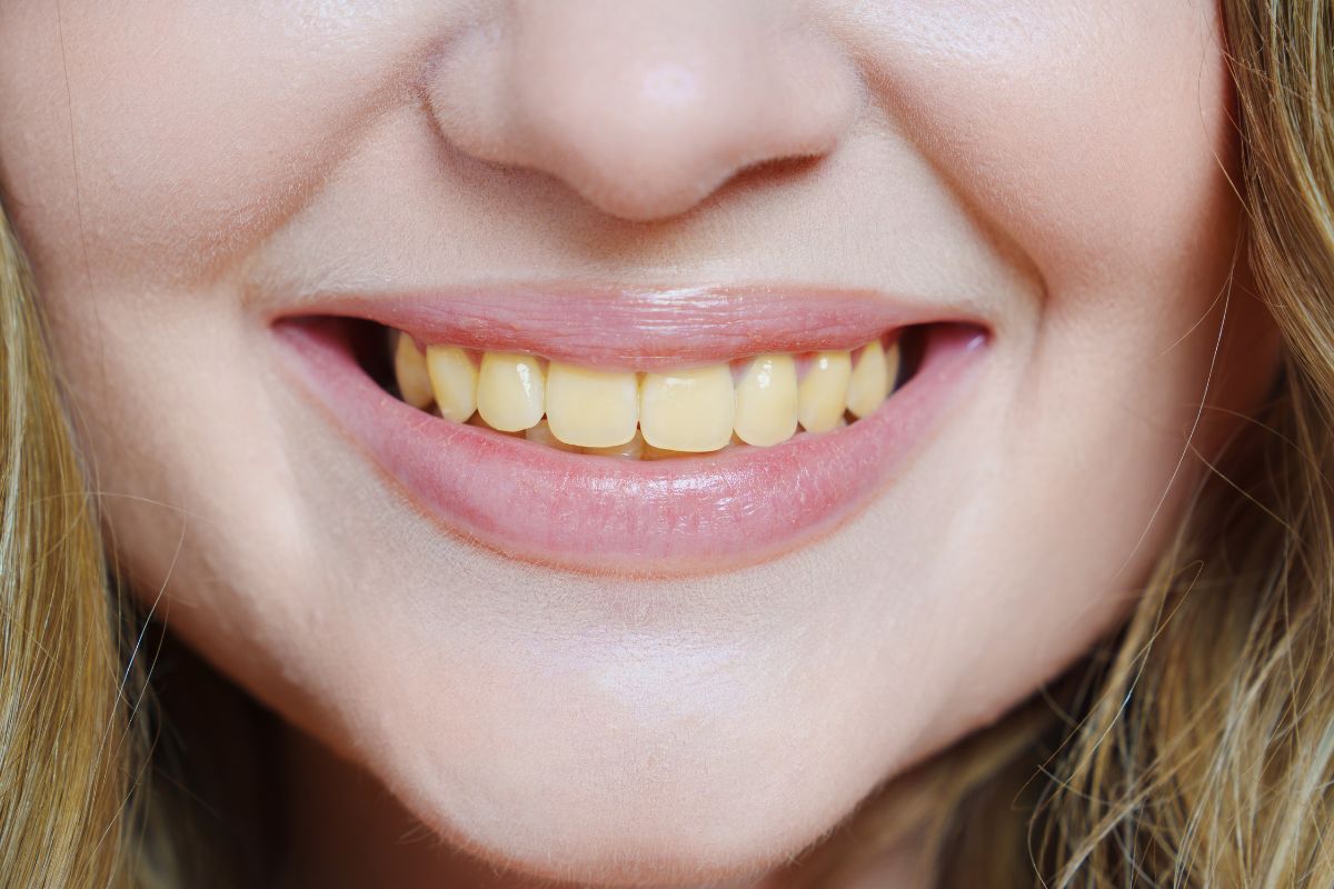 Problèmes de dents jaunes et consultation dentaire
