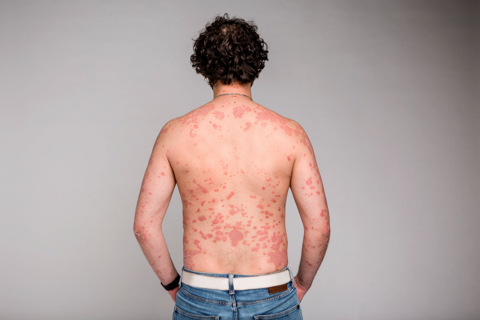 Consultation médicale pour le psoriasis