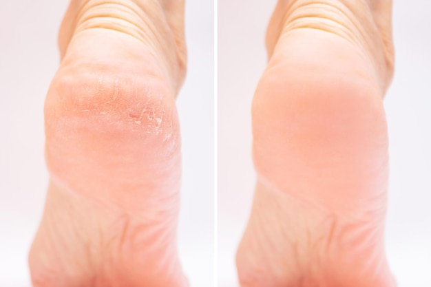 Comparaison avant et après soin des talons