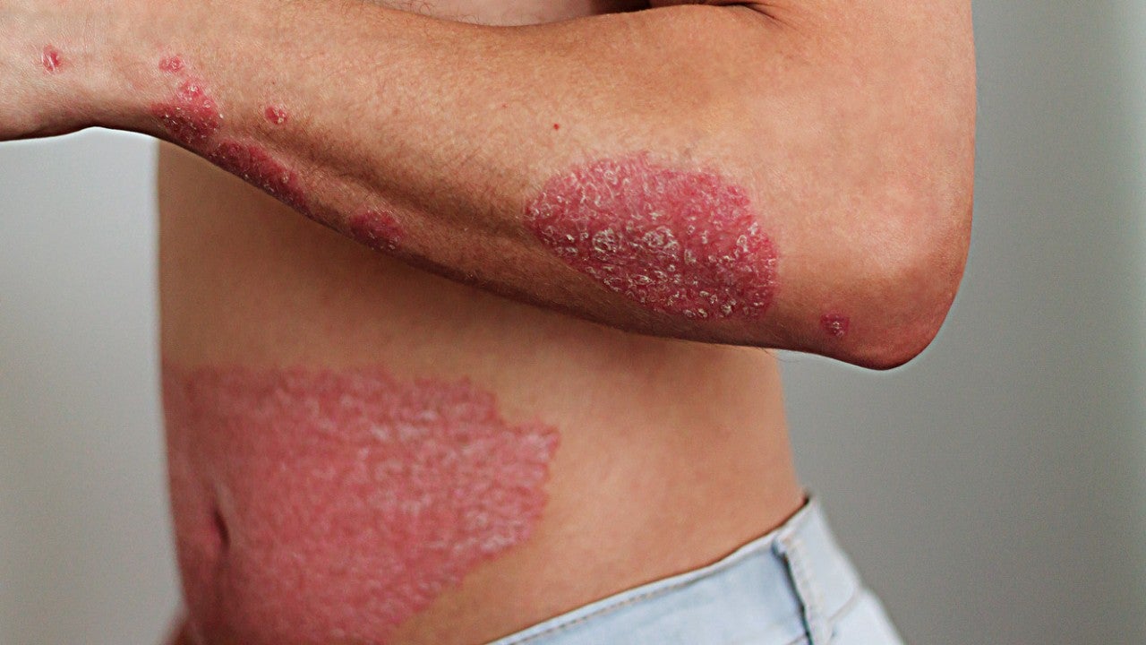 Détail de plaques de psoriasis sur la peau