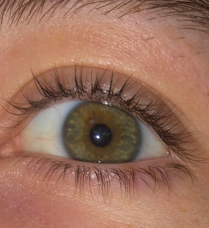 Double rangée de cils sur la paupière