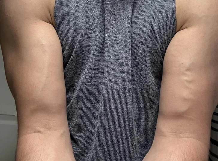 Différences veineuses entre les deux bras