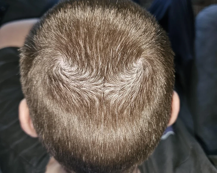 Double couronne de cheveux sur la tête