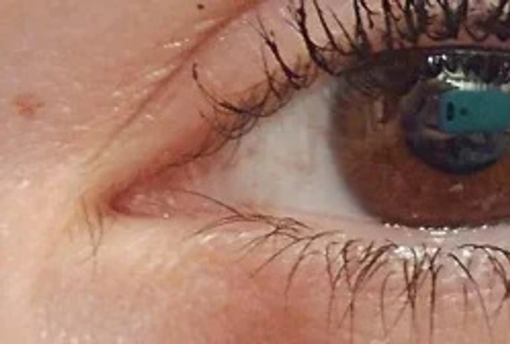 Cils poussant dans l'angle interne de l'œil