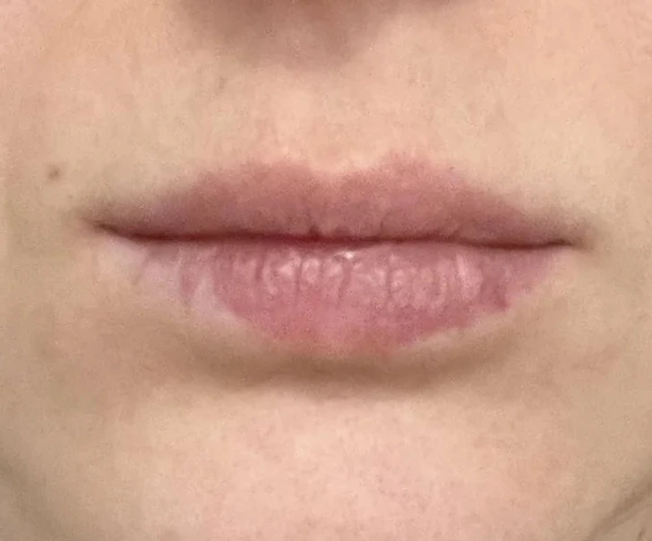 Lèvre inférieure avec zone dépigmentée