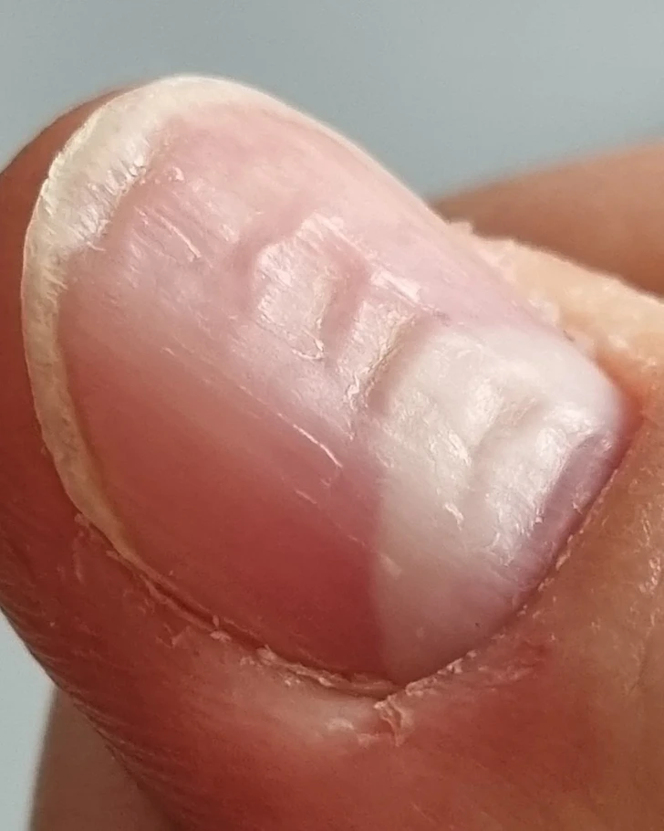 Ongle strié avec des rainures profondes